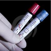 HIV-Negative AIDS: Is it CFIDS or AIDS?